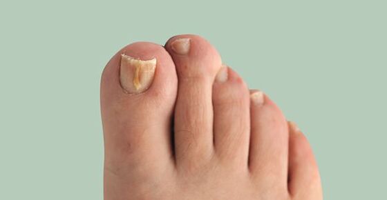 Nagelpilz